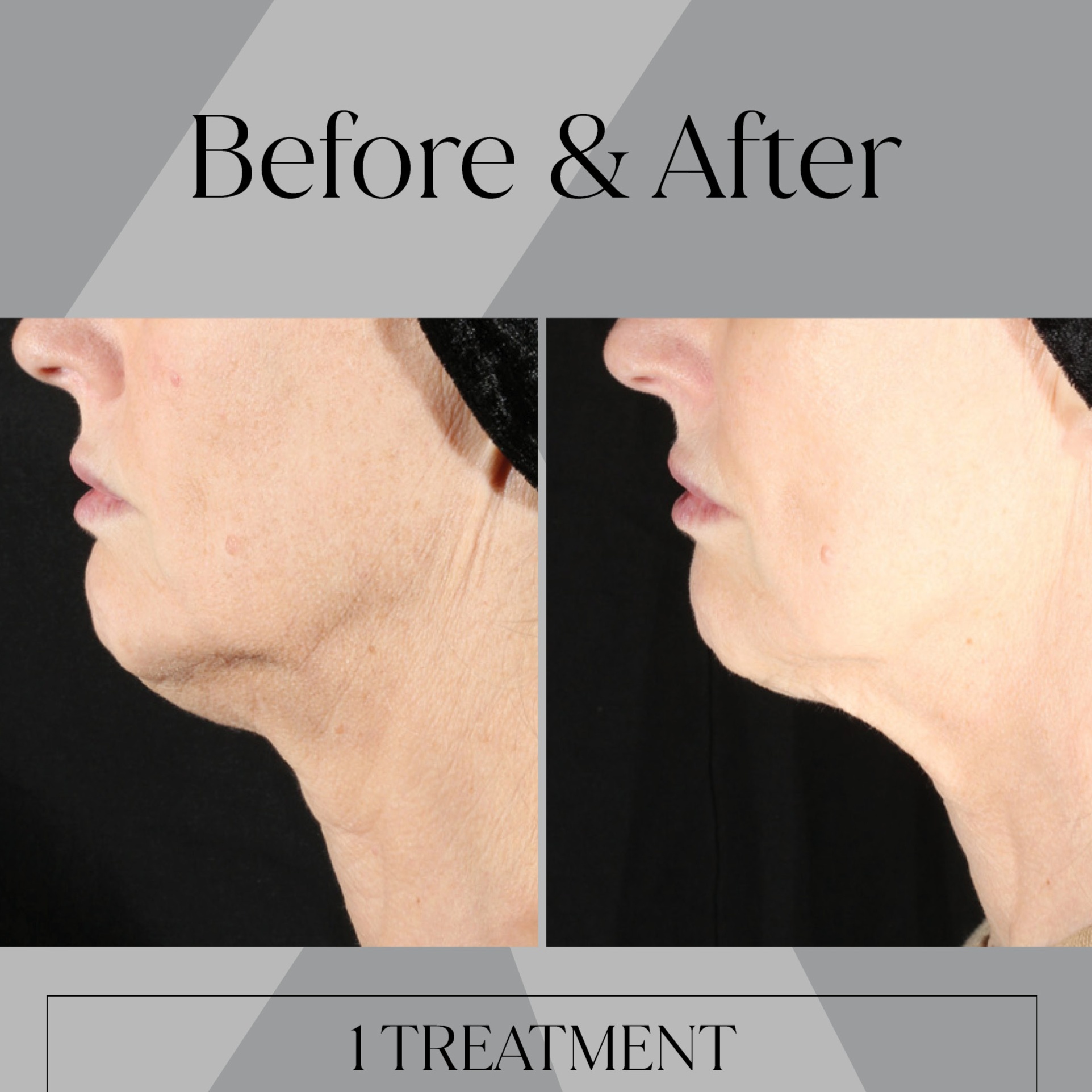 XERF® Skin Tightening (1 Session) at Karisma Esthetics in Melbourne, FL