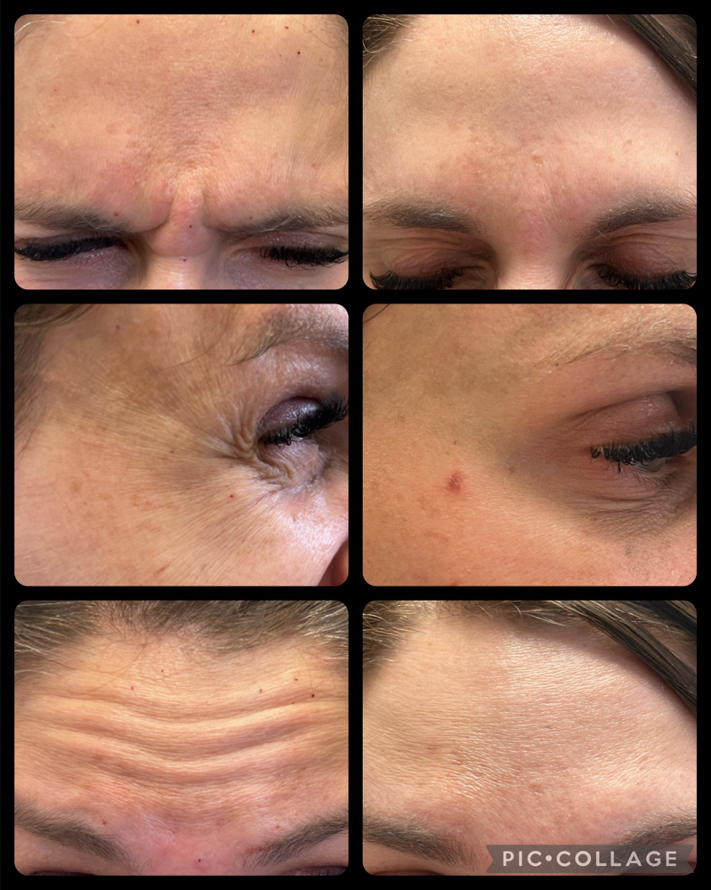 Toxins (botox, Dysport, Jeuveau)