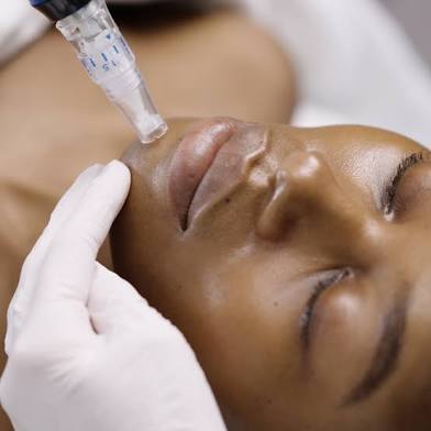 Microneedling (ADD ON)