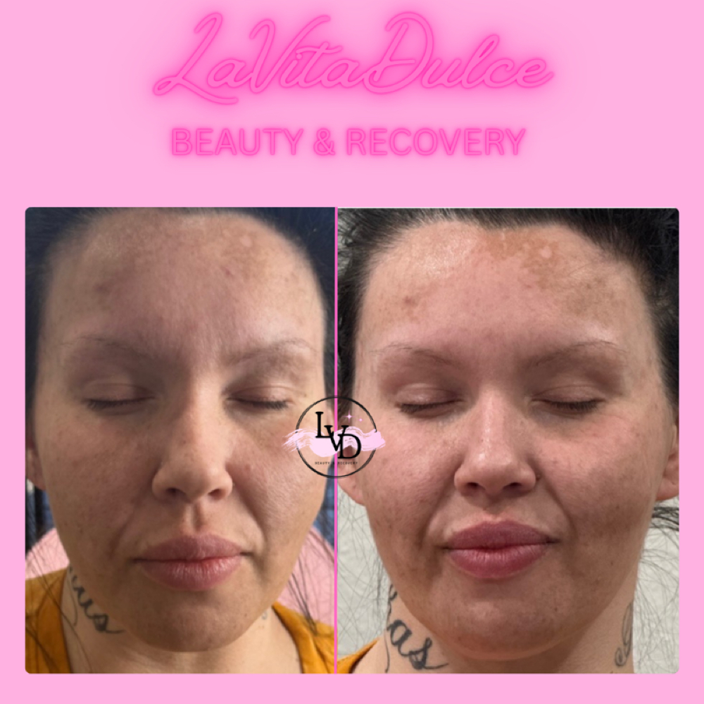 Temple Restoration at LaVitaDulce Beauty&Recovery Services in Weatherford, TX