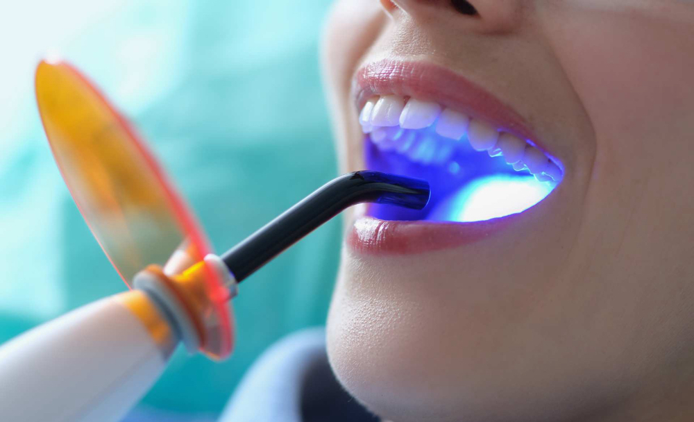 Teeth Whitening BOOST Session