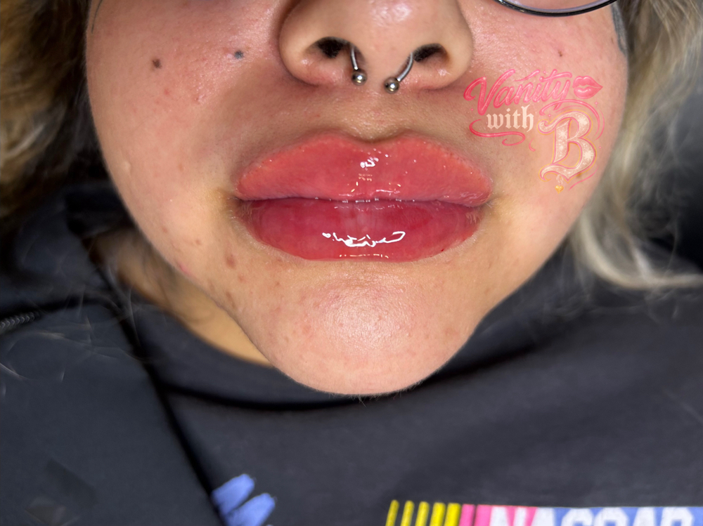 Lip Filler 1 ML