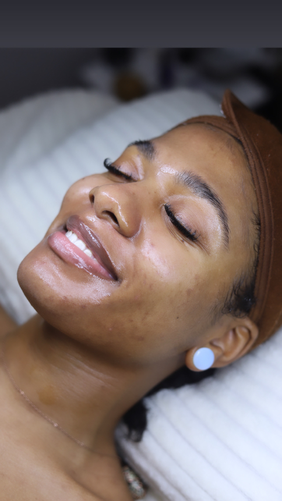 Chemical Peel (Acne Lift )