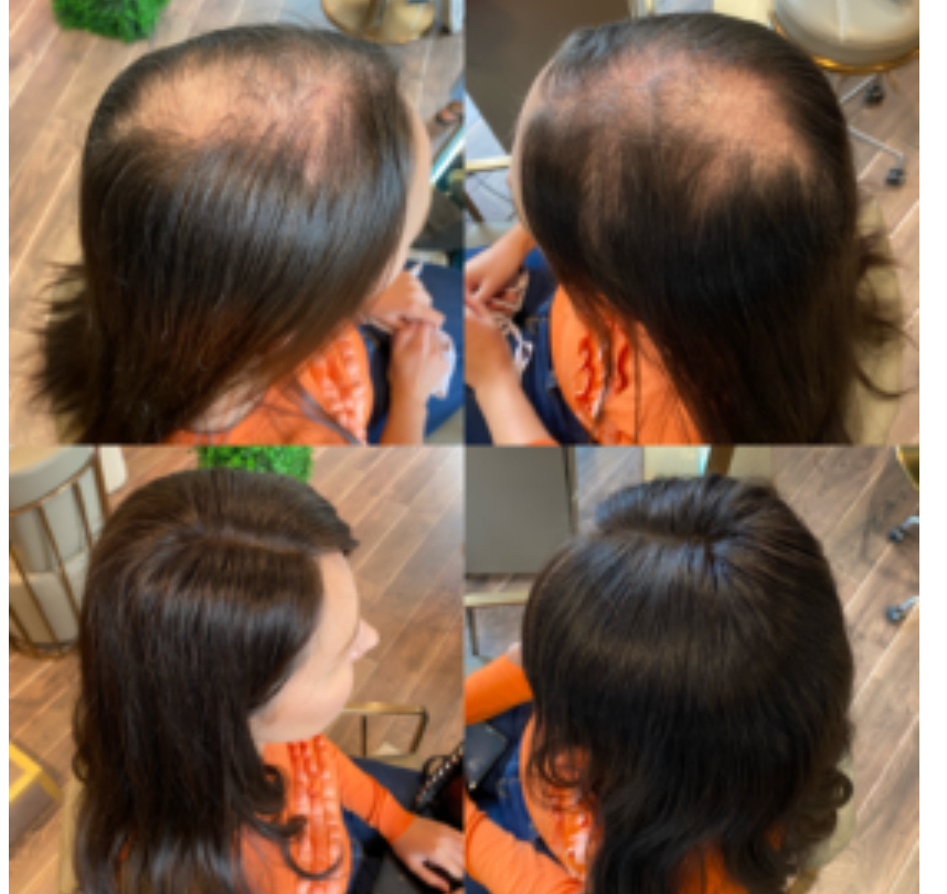 Hair Replacement Systems
