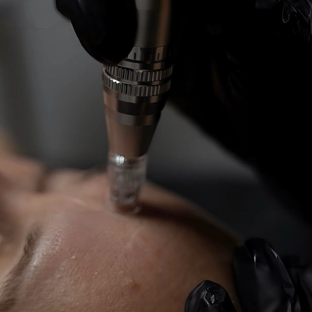 MICRONEEDLING FACIAL at Skin and Ink in Lincoln, NE
