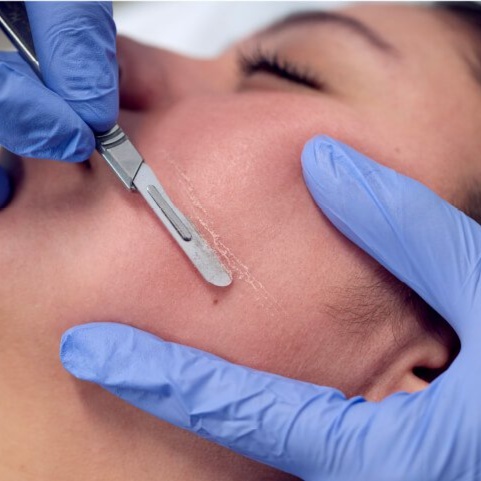 Dermaplane at Auraluminous Beauty in East Rutherford, NJ