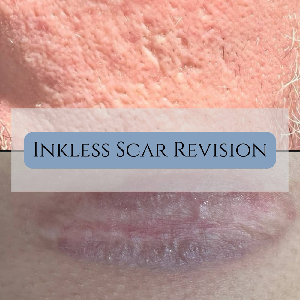 Inkless Scar Revision at Carolina Restorative Aesthetics in Greer, SC
