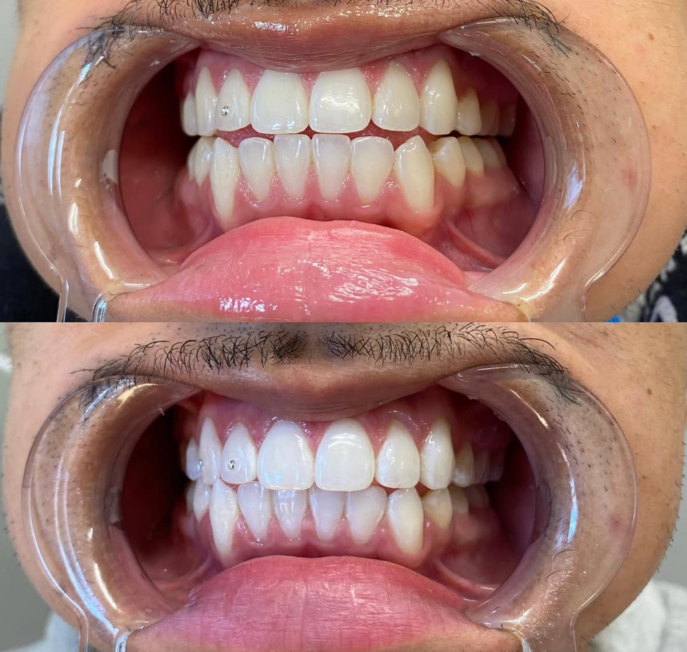 Teeth Whitening at BeautyByBernice in San Antonio, TX
