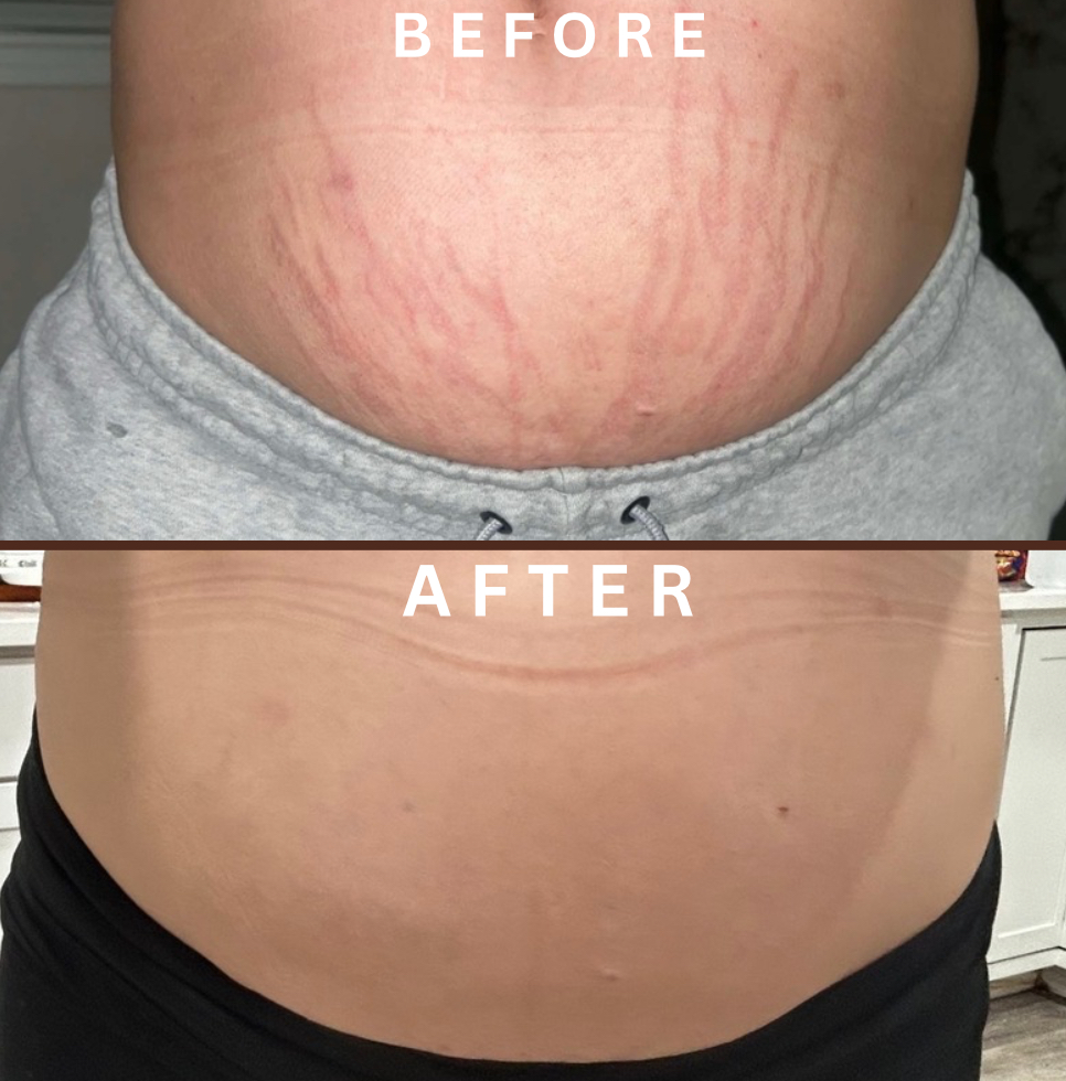 Ink-Less Treatment