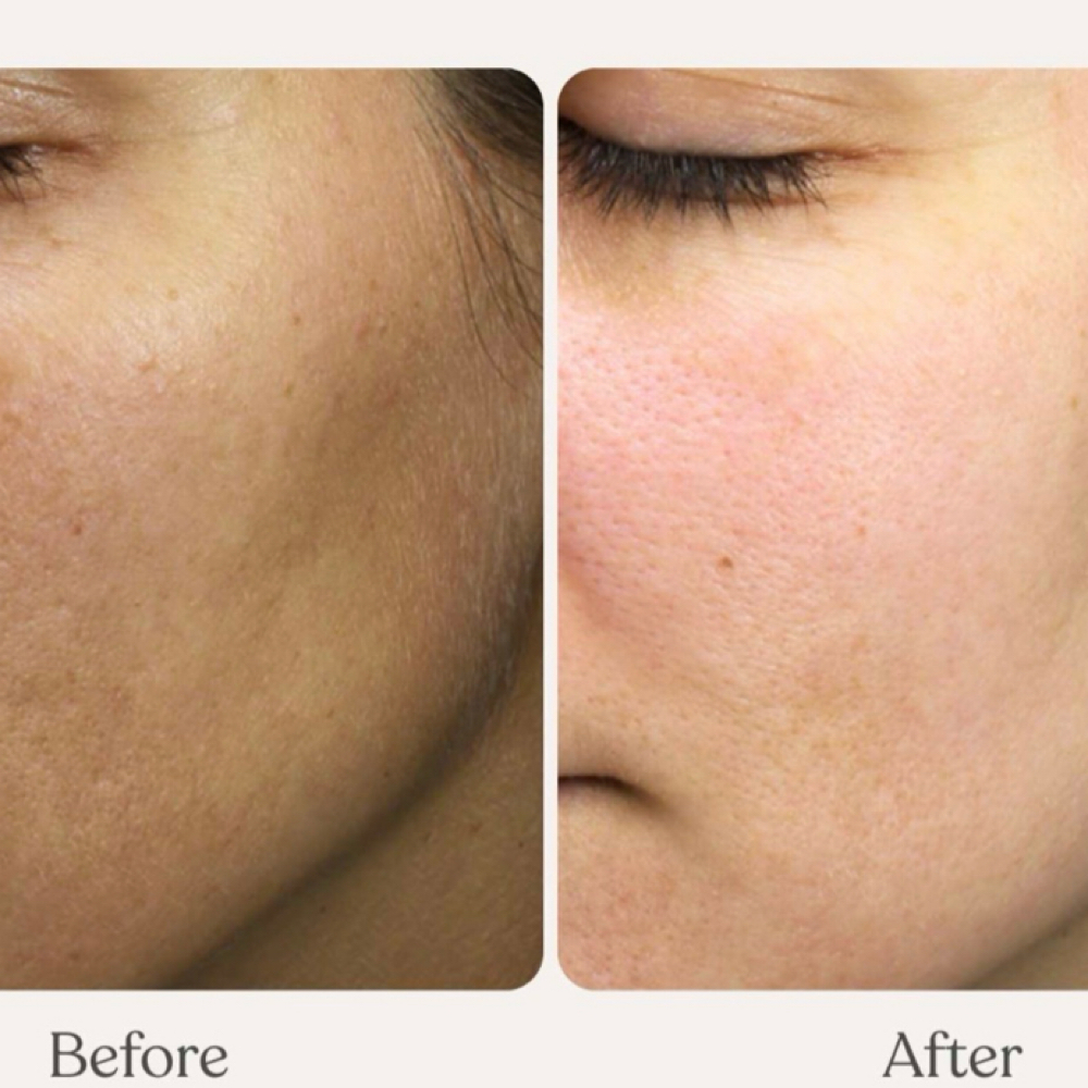 Photofacial Plus Microneedling at Amy Donaldson Nurse Injector in Westport, MA