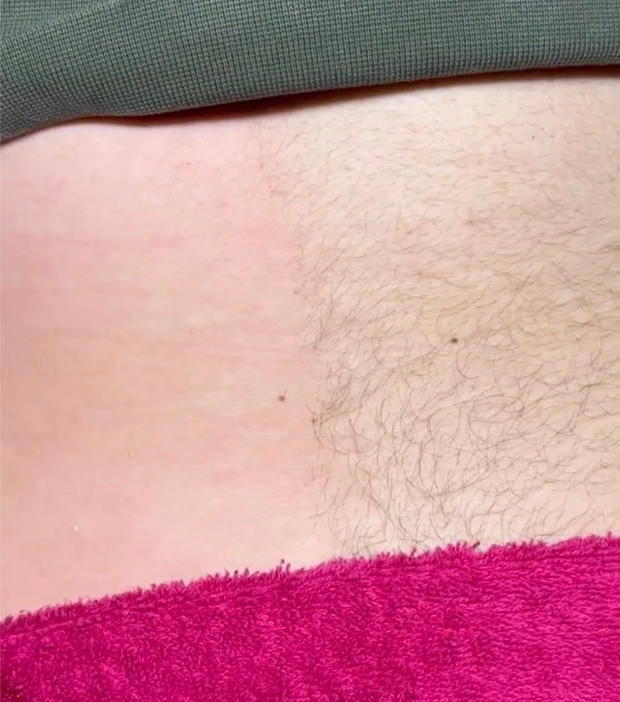 Midsection Sugaring