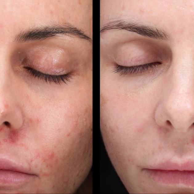 Green Power Peel at Sage Skin & Aesthetics in Kennewick, WA