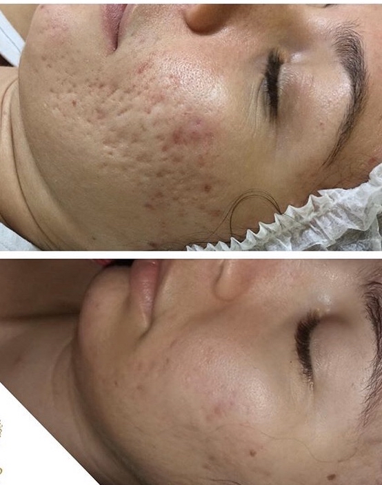 Acne Scars Treatment + Steam Cells