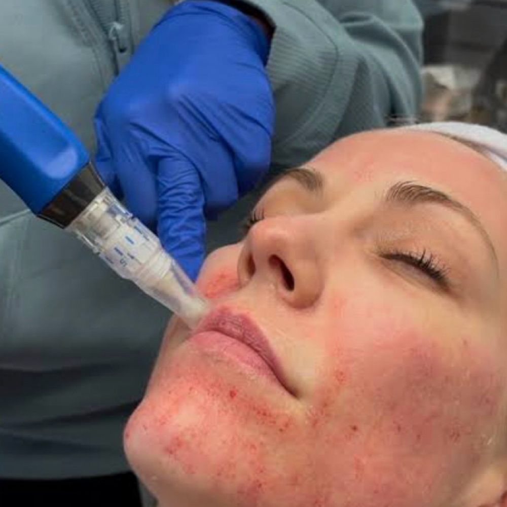 Tratamiento Con Microneedling at Colorado Beauty Bar in Aurora Colorado, CO