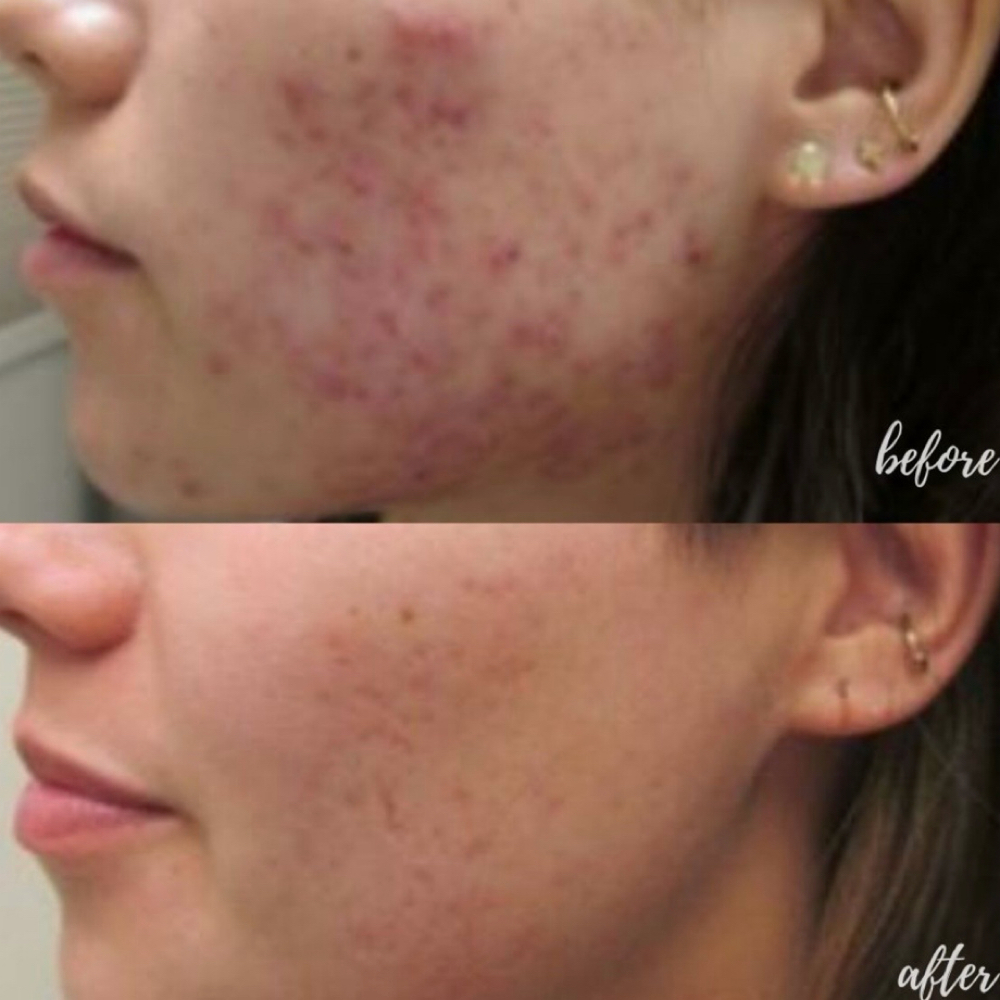 Acne Scar Renewal Series at 3CSkin, LLC in Wauchula, FL
