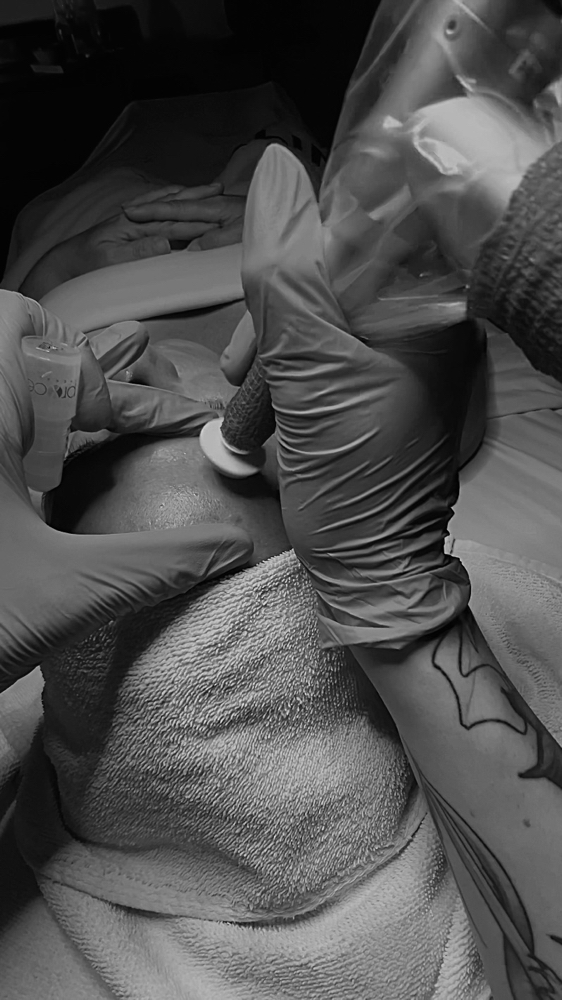 Microchanneling at Moss & Blade in Sarasota, FL