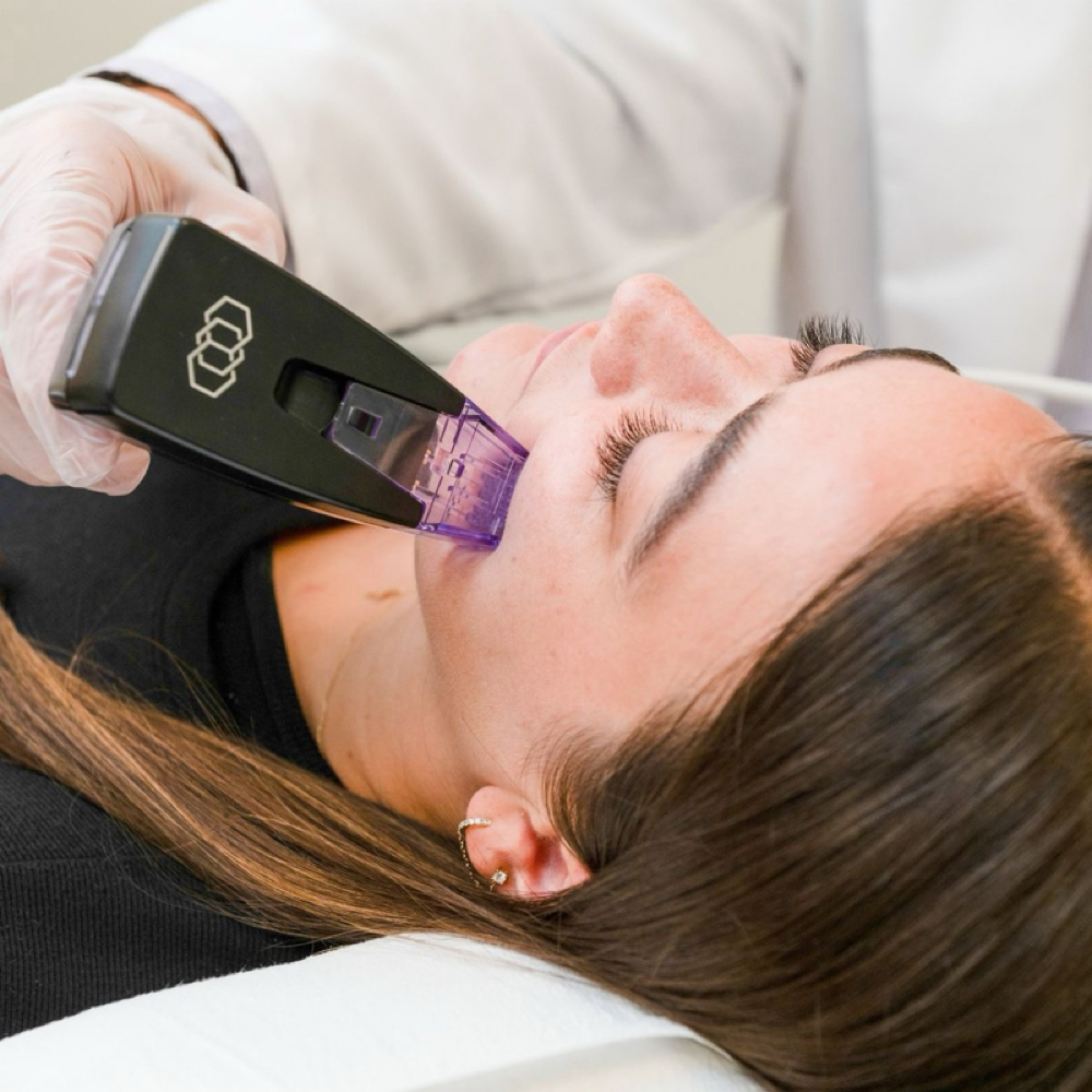 Morpheus8 Face at Covalence Medical & Aesthetics (Graceful Touch) in Sarasota, FL