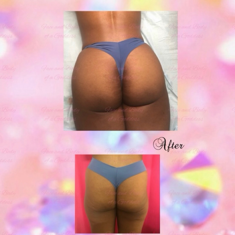 Liquid BBL at Ayona’s Medspa and Beauty Bar in Newnan, GA