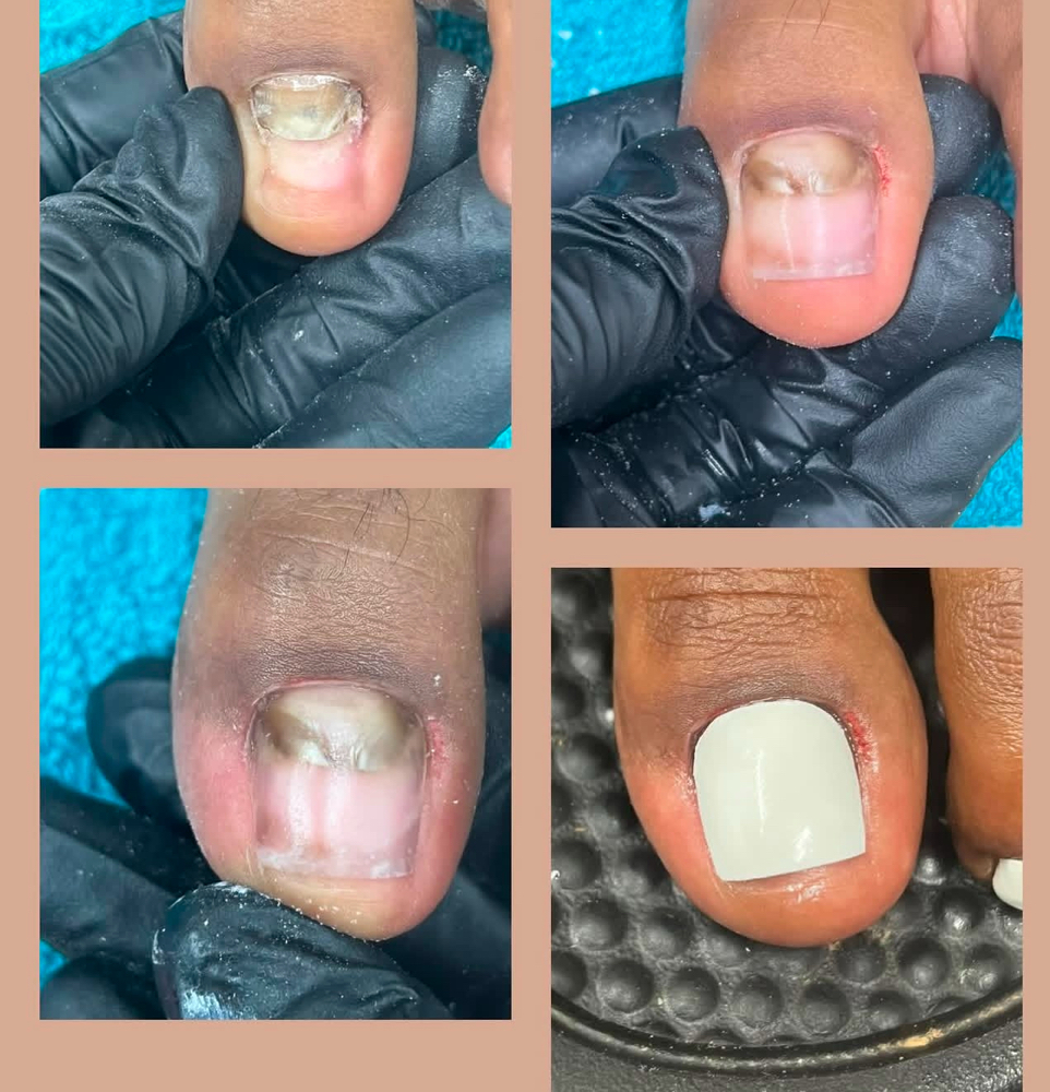 Acrylic Toe
