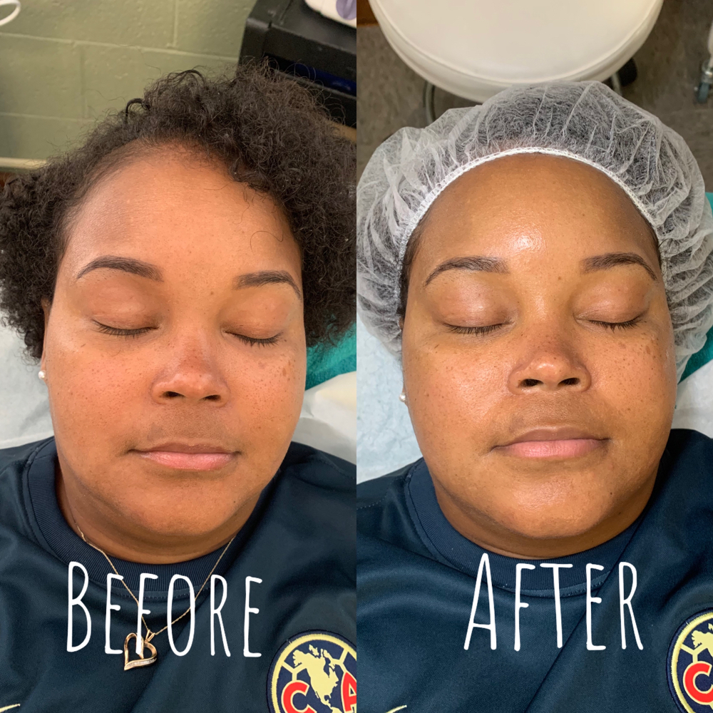 Lip/chin Wax