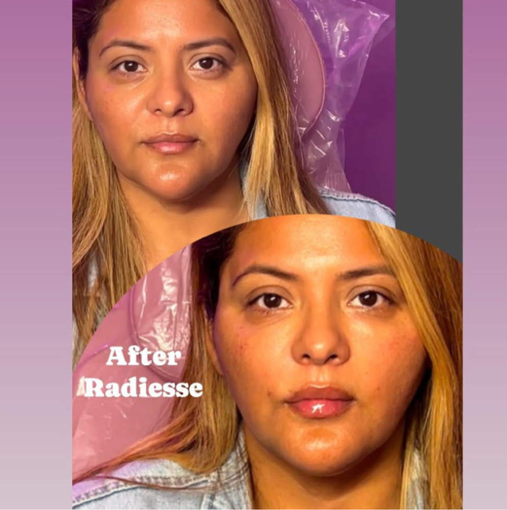 Radiesse Full Face Collagen Treatme at Flawless Spa & Beauty in Fort Worth, TX