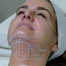 Fat Dissolving chin W/RF at Polished Physique in HOBOKEN, NJ