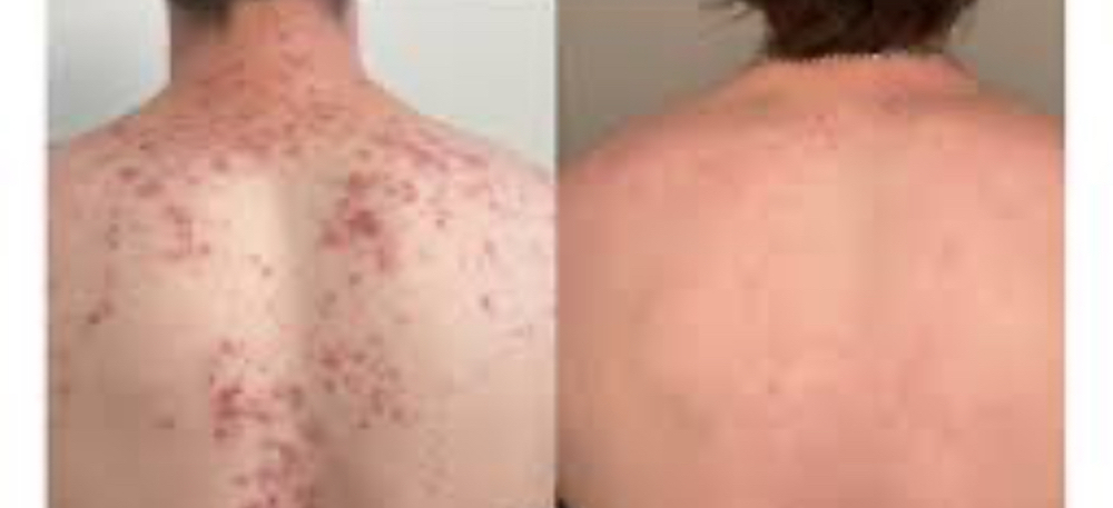 Decollete (chest) or back facial