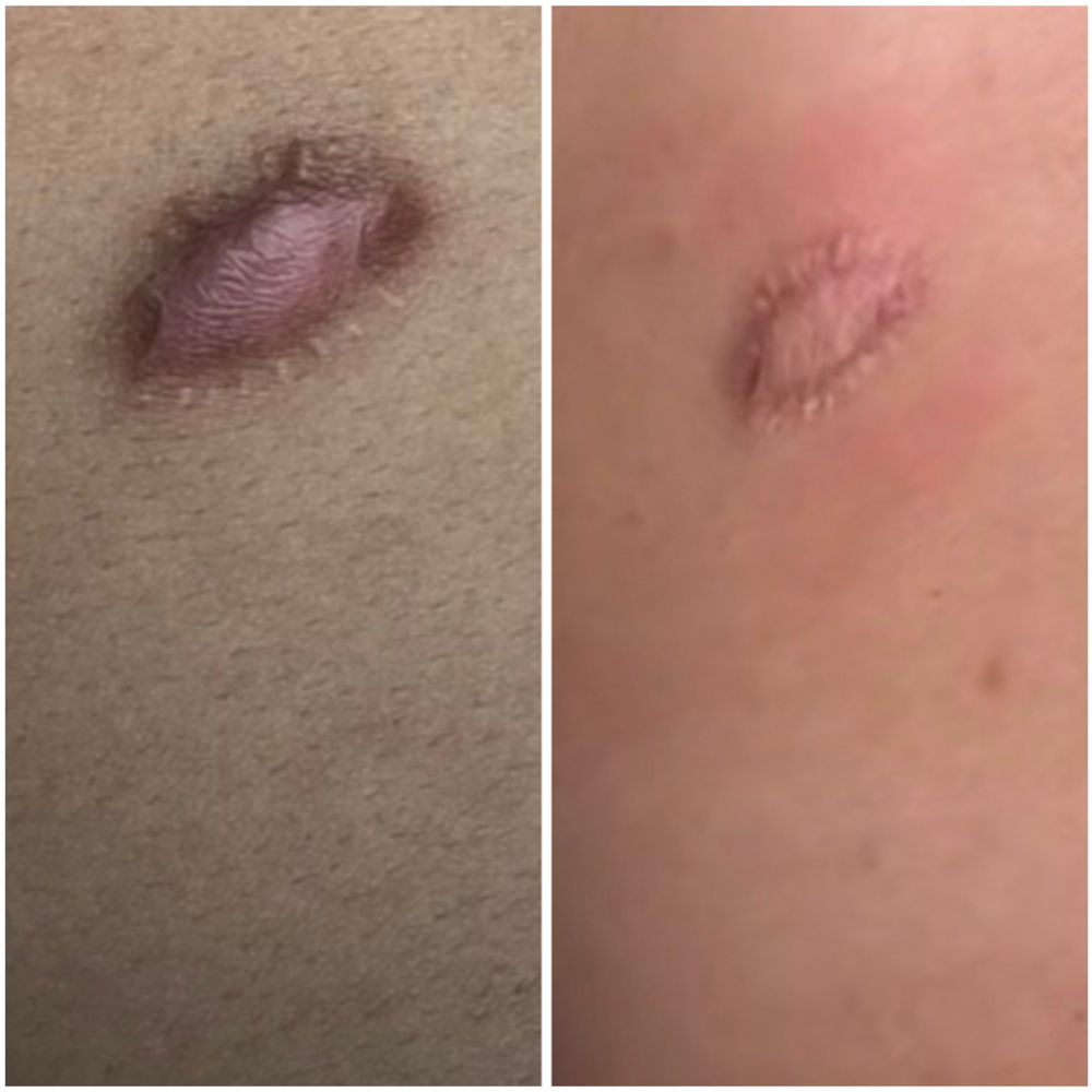Small Area Scar Revision at Balance.Bar.Aesthetics in Vallejo, CA