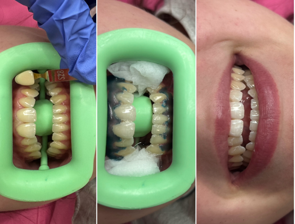 Teeth Whitening With New Kit