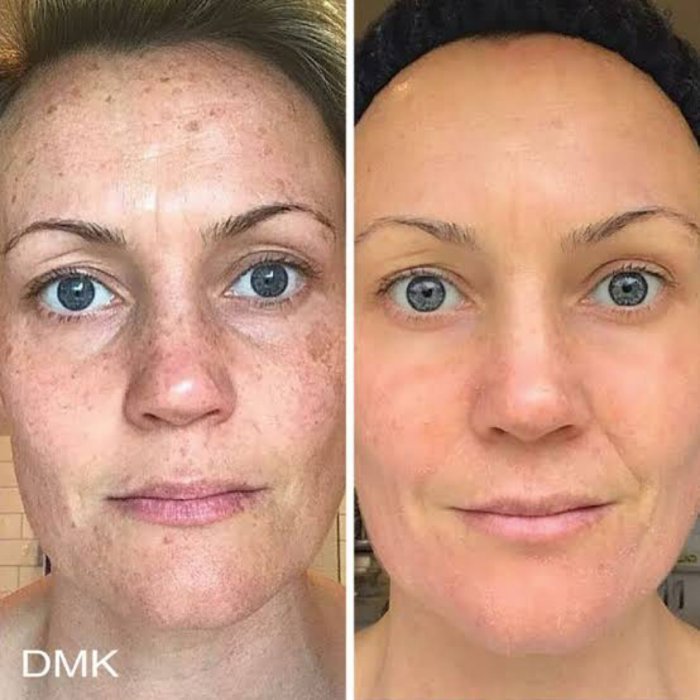 DMK Skin Reset (First Visit) at Aesthilex in Beverly Hills, CA