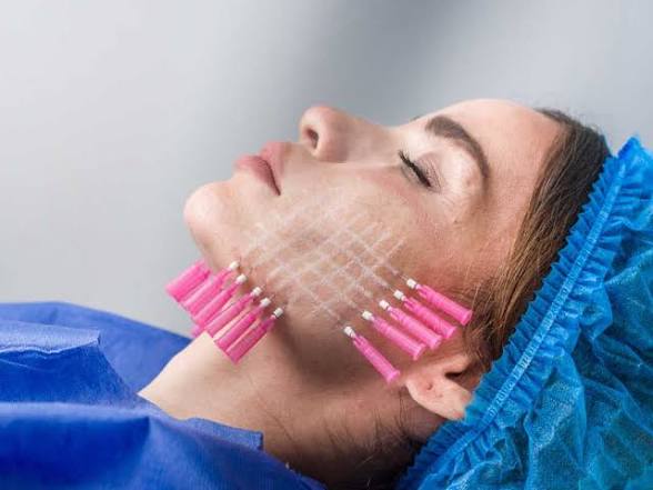 Hilos PDO/PCL at Natural Glow in Grand Praire, TX