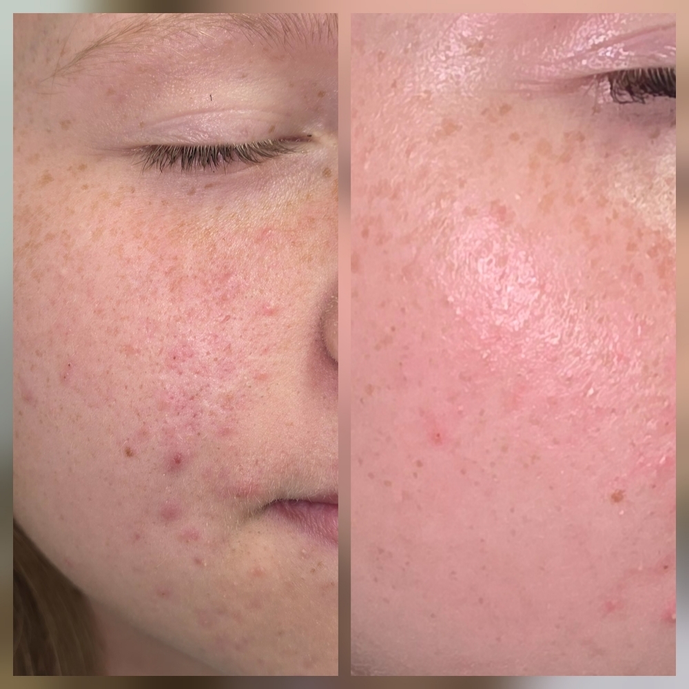 Clarifying Acne Treatment at Celtic Spa Laser Services in Attleboro, MA