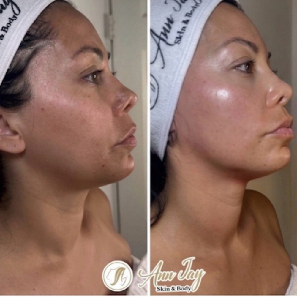 The Jawline Sculpt at Ann Jay Skin & Body in Clifton, NJ
