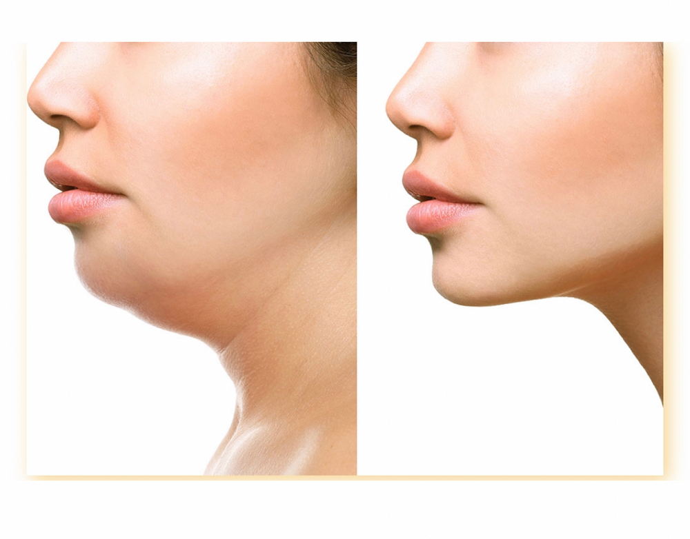 Fat lipolysis/kybella Holly