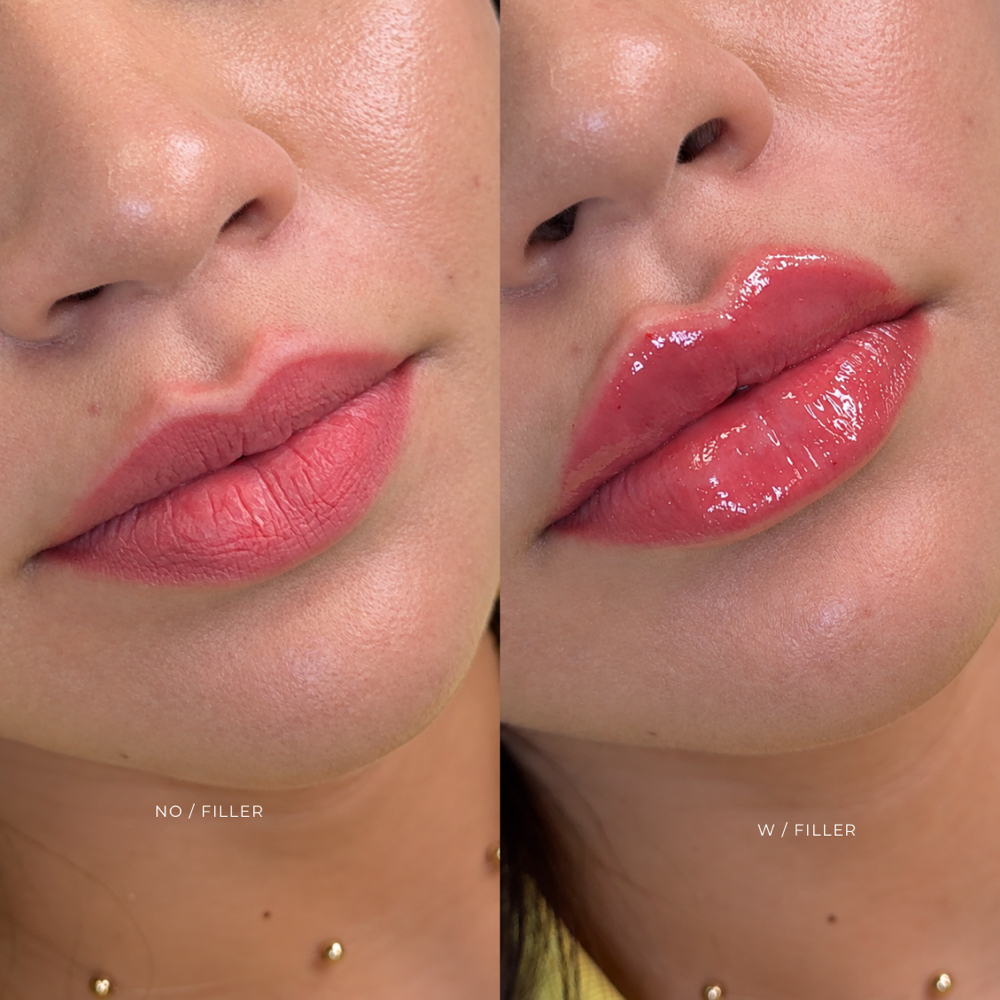 FILLER | RUSSIAN LIPS at EROXSPA in Houston, TX