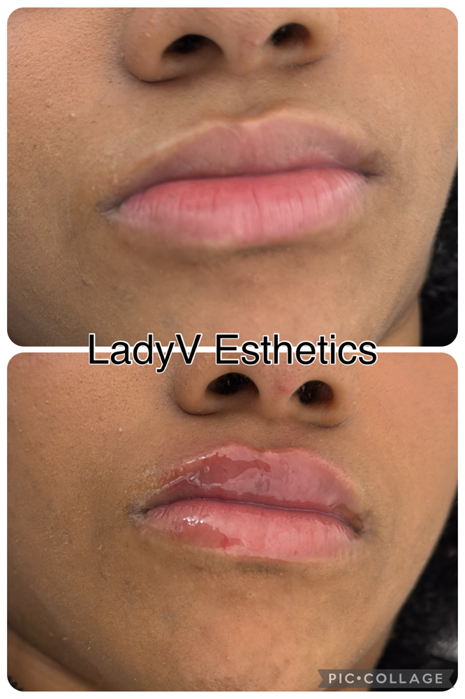 Hylaron Lip Fillers 2.5ml
