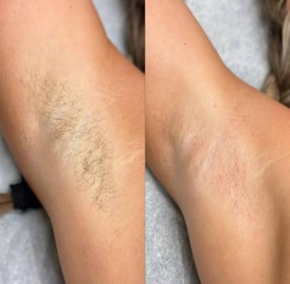 Underarm Wax