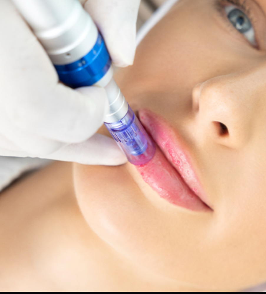 Microneedling Lip Plump Tx