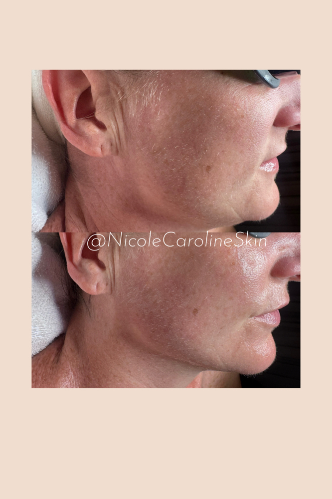 The Insta-Lift ™ treatment