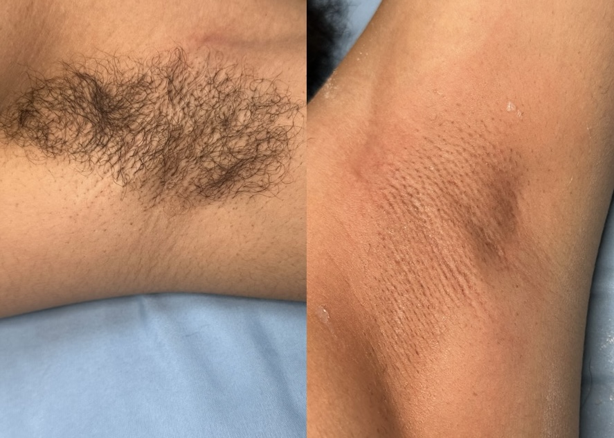 Underarm Wax at ACESTHETICS LLC in Milford, CT