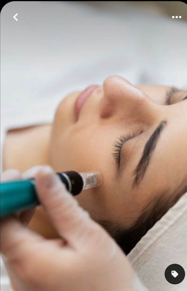 Microneedling