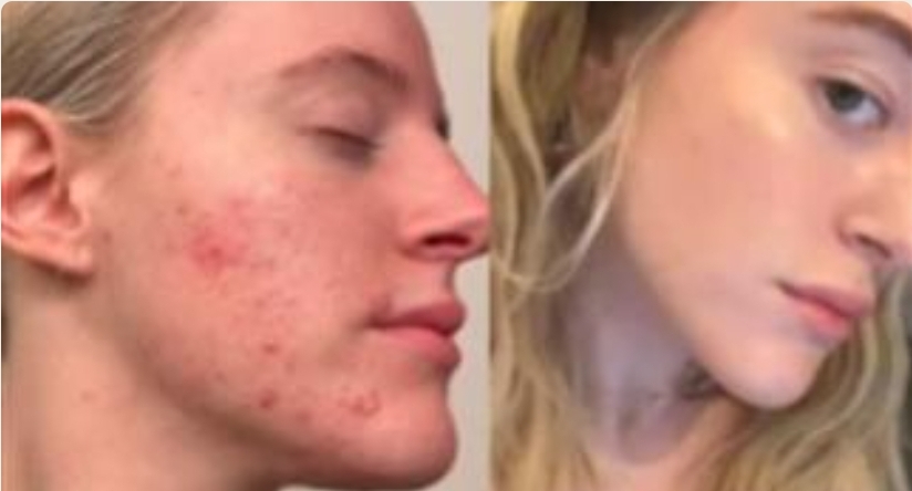 Cell Story Microneedling Treatment