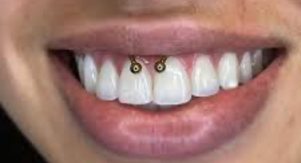 Smiley Piercing