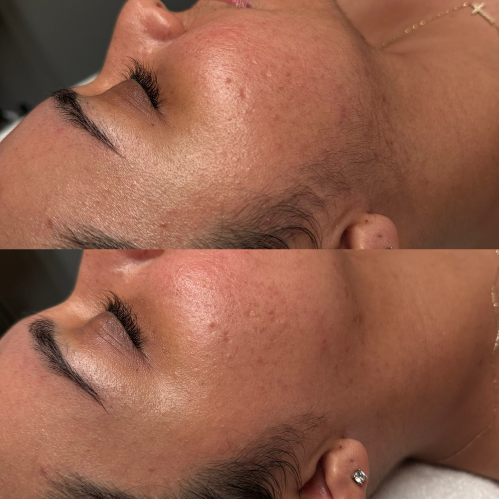 The Dermaplane Facial at EstheticsHD in Naples, FL
