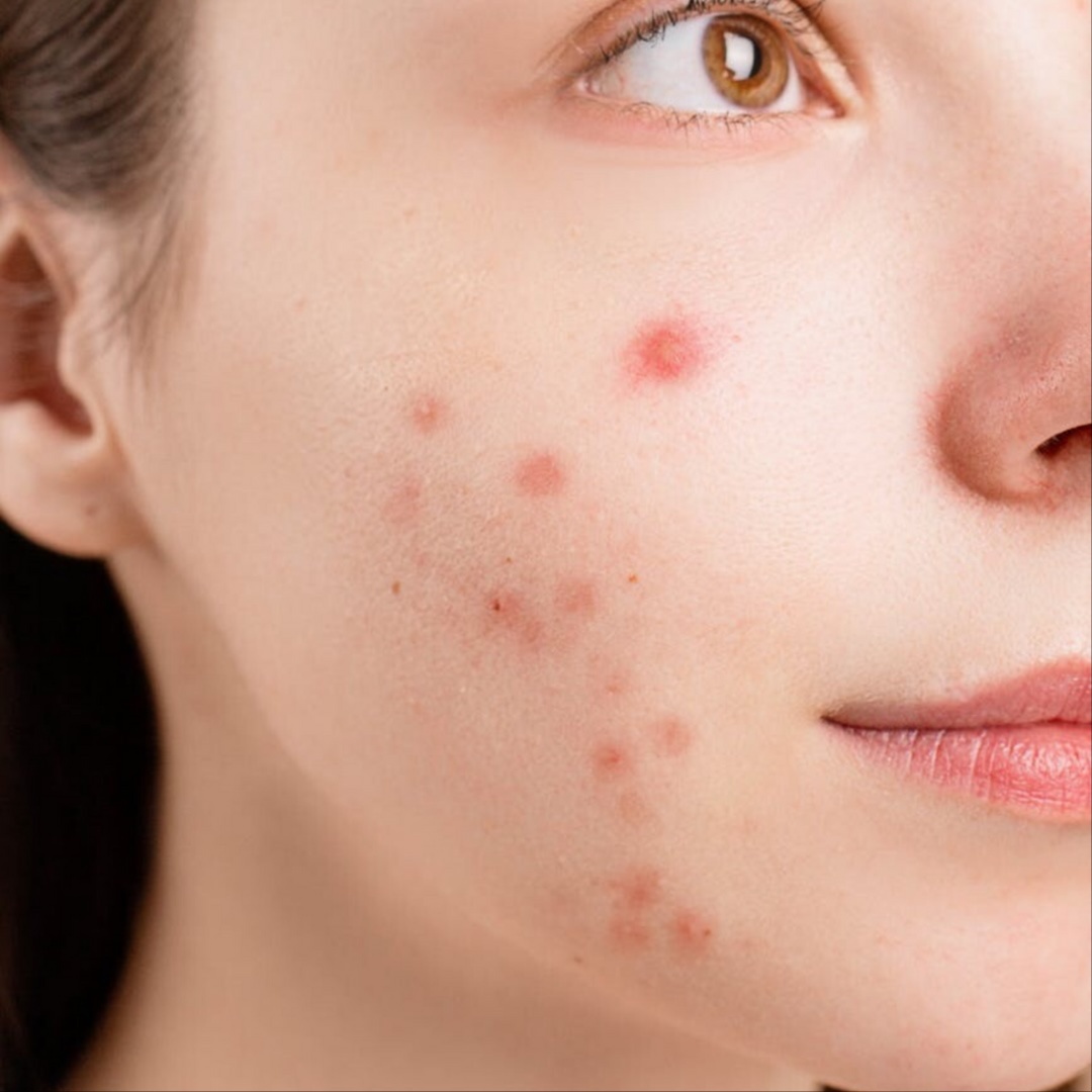Teen Facial at FaceMe Skin Care in Bloomingdale, IL