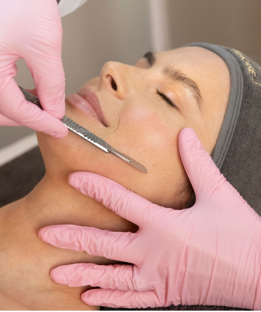 Dermaplaning