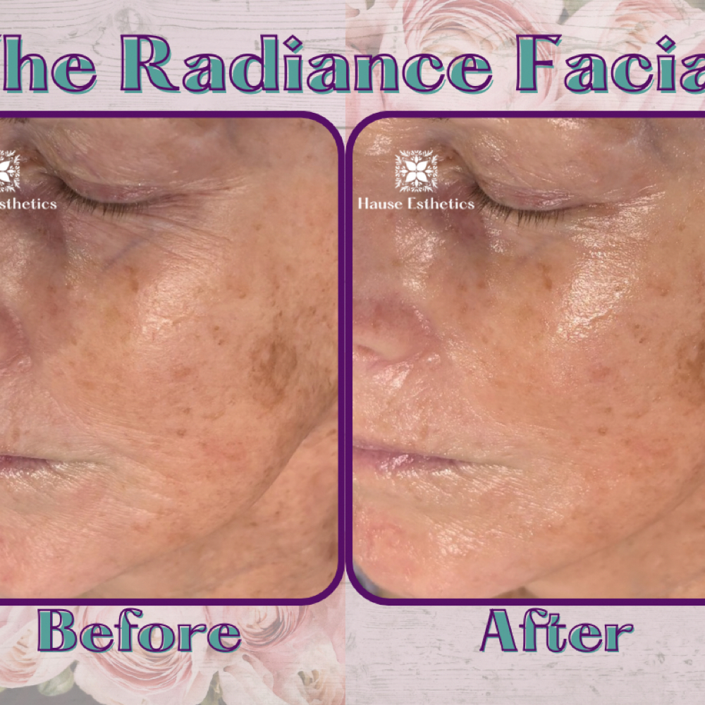 The Radiance Facial at Hause Esthetics in Morristown, TN