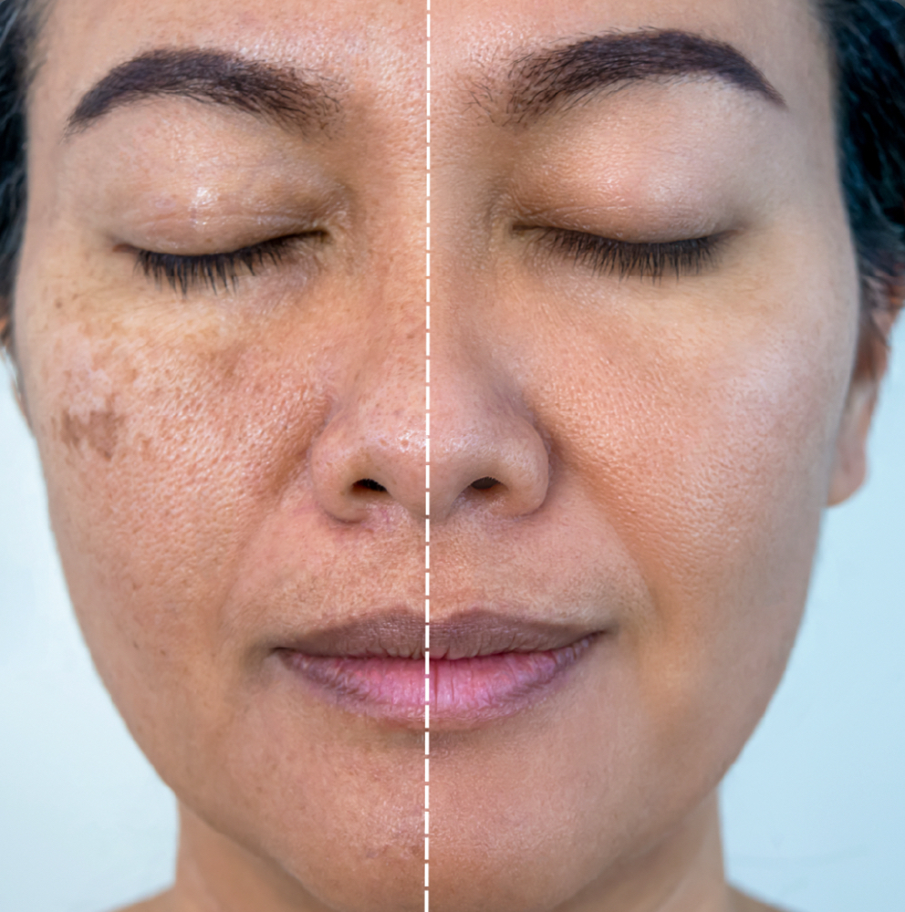 Bio Exfoliation Treatment