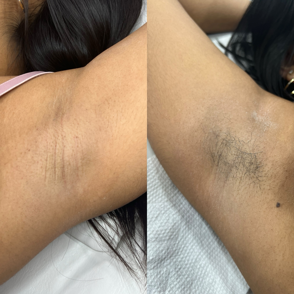Underarm Waxing