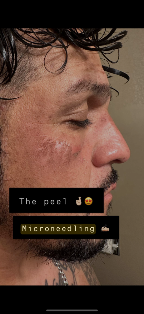 Microneedling at House of Esthetics LLC in Casa Grande, AZ